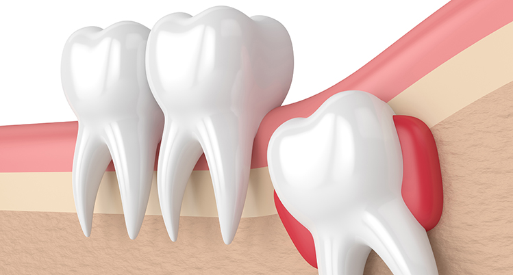 サージカルガイド