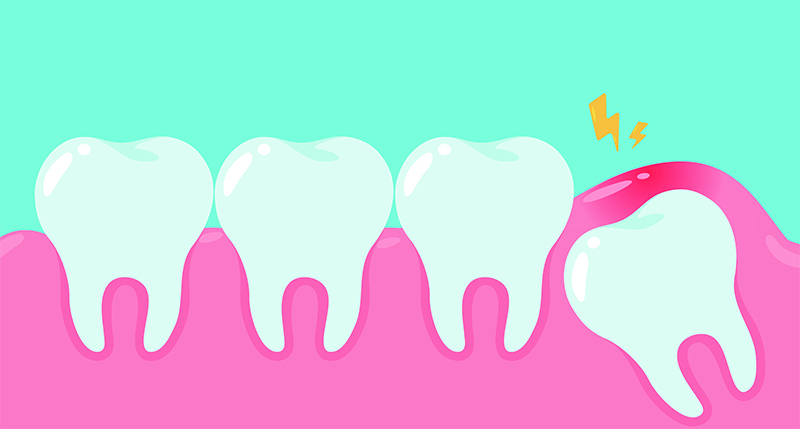 サージカルガイド