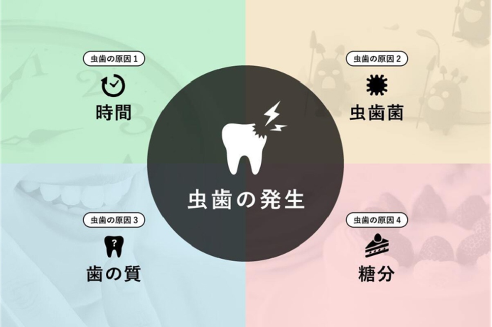 虫歯ができる4つの原因