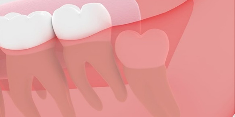 親知らずを抜かなくても問題ないケース