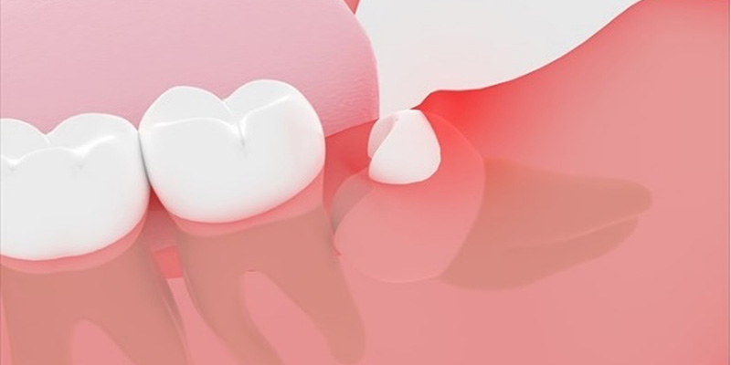 親知らずを抜いた方が良いケース