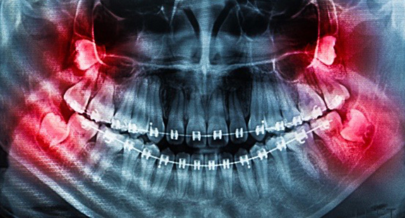 親知らずの晴れの原因