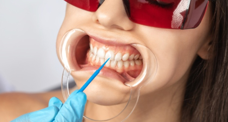 オフィスホワイトニング