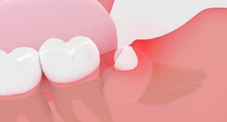 抜歯の必要がある親知らず