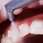 歯のクリーニング