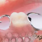 入れ歯