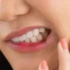 知覚過敏について