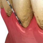 歯周病